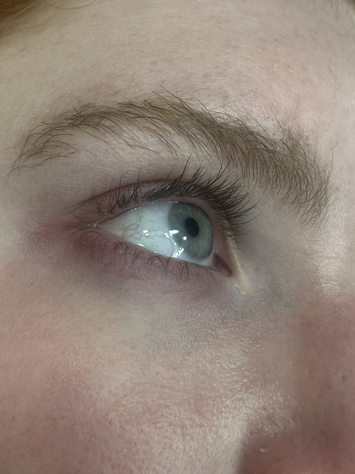 I started seeing a difference by week 3 and now I’m obsessed! No redness, no irritation, just actual results.